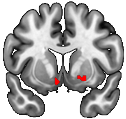 A cross-sectional brain from MRI with activity in ventral striatum